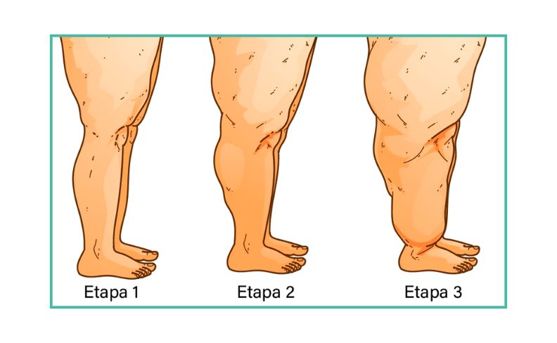 las etapas del lipedema en la pierna de una mujer